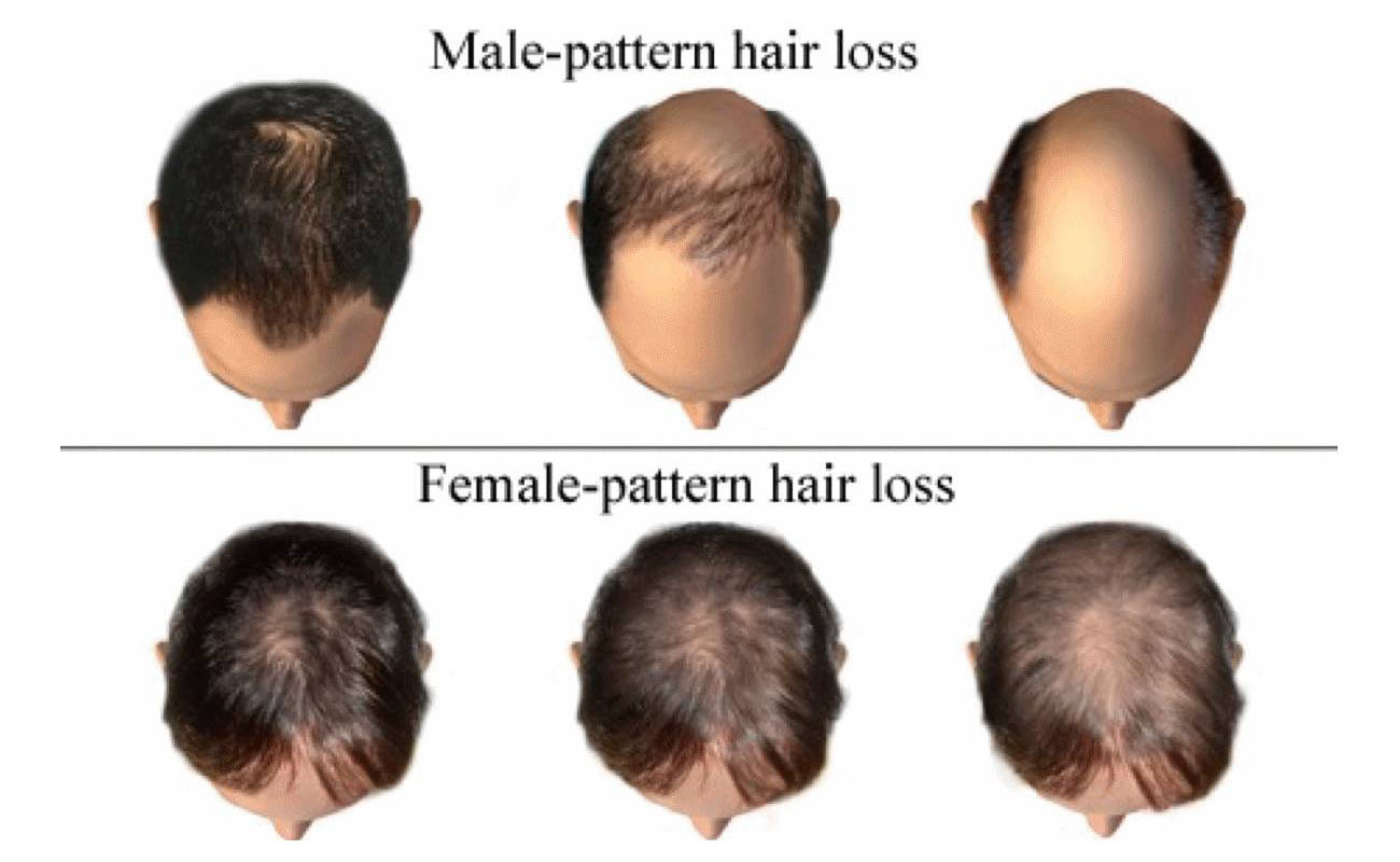 Perhatian Ini Tanda Tanda Kebotakan Yang Perlu Diketahui   Pattern Hair Loss 